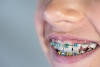 Ortodoncja dla dzieci: Kiedy zacząć leczenie i dlaczego jest ważne