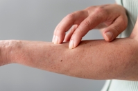 Wszystko, co powinieneś wiedzieć o atopowym zapaleniu skóry: od objawów do leczenia